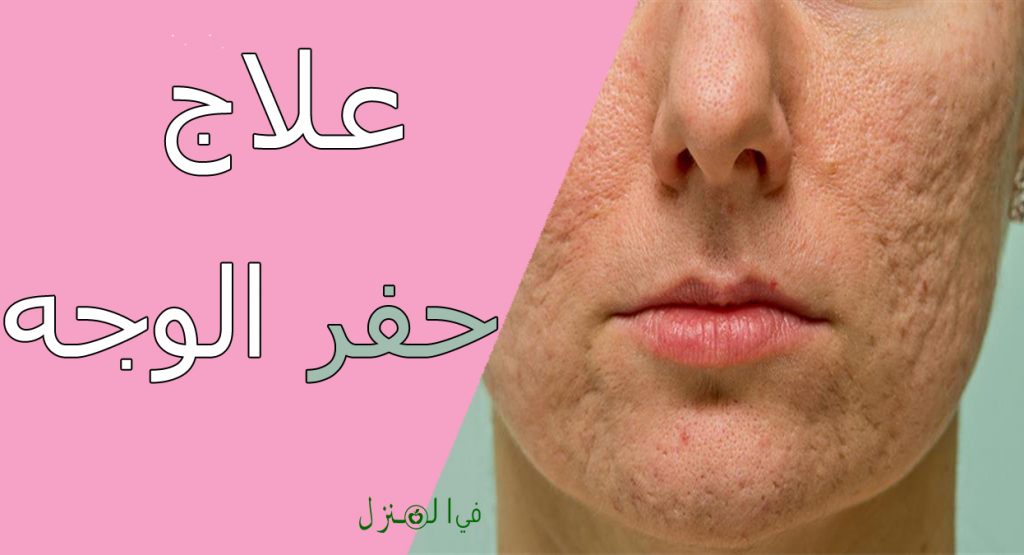 أفضل كريم لعلاج حفر الوجه